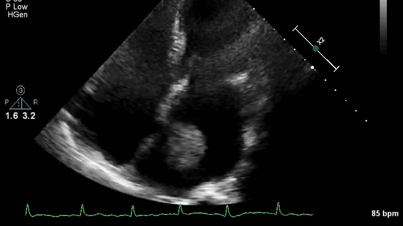 心源性栓子脱落致急性截瘫一例超声心动图