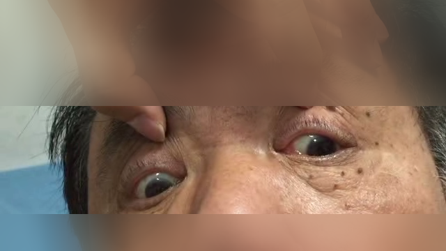 跷跷板眼震患者体征