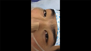 抗N-甲基-D-天冬氨酸受体脑炎伴发视阵挛患者的视阵挛症状